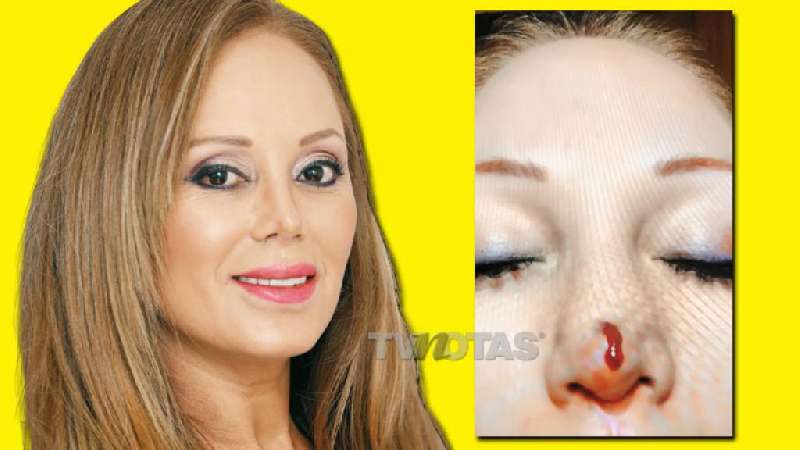 Ivonne Soto casi pierde la nariz tras hacerse rinoplastia
